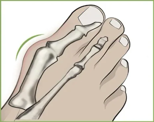 Hallux Valgus Toe Spreader